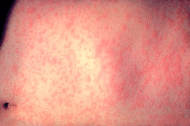 This is the skin of a patient after three days of measles infection.