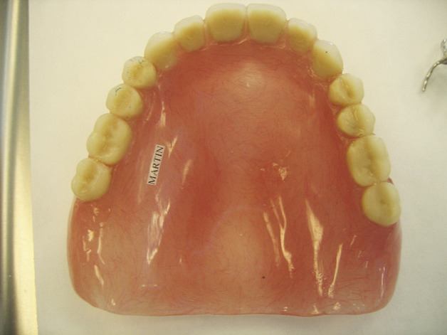 An example of dentures