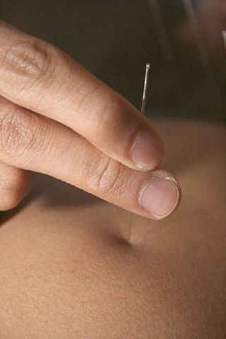 Acupuncturist Jeffrey Medina inserts a needle into patient Michelle Gonzaga’s upper back.