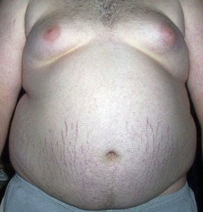 Federal Way has the third highest adult obesity rate in King County