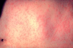 This is the skin of a patient after three days of measles infection.